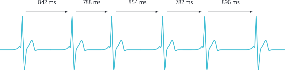 HRV (herzratenvariabilität) R-R Zacken Graph